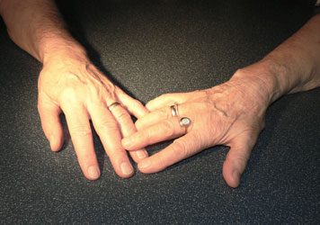 Geteilte Nieren, gemeinsames Glück: Anneliese und Wolf S. halten zusammen